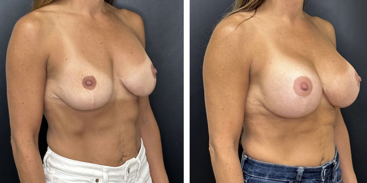 before and after breast implant revision right angled view case 1416