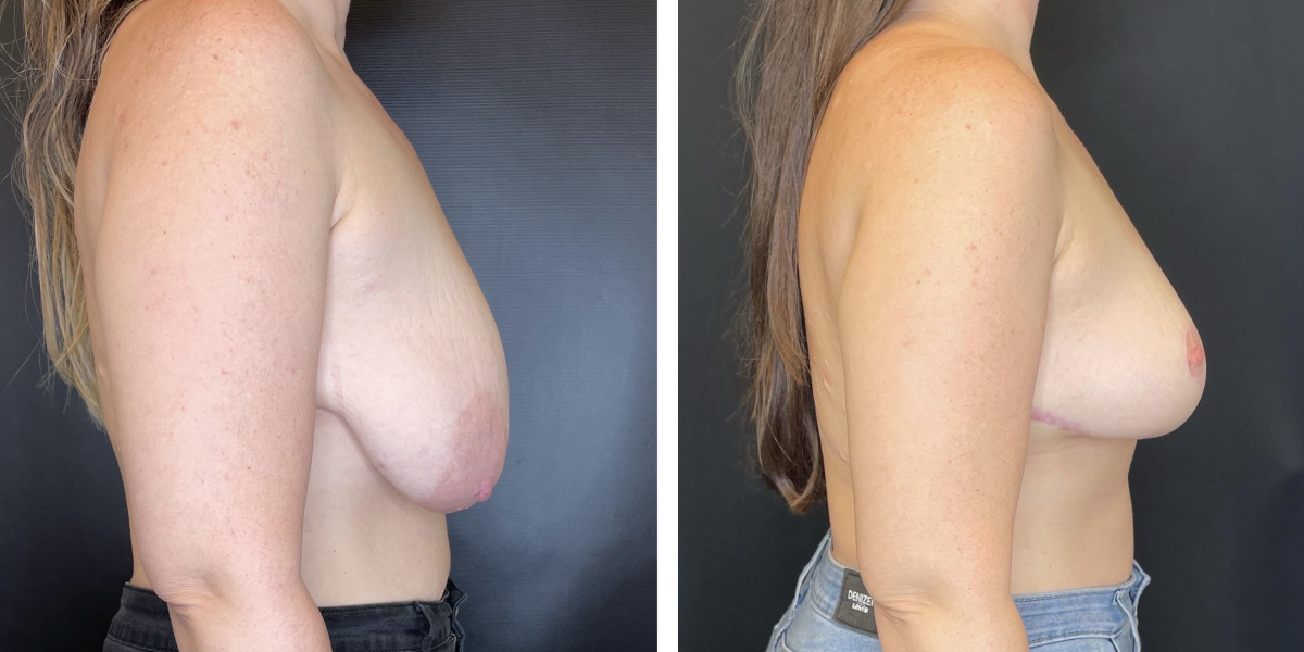 before and after breast lift right side female patient case 1317