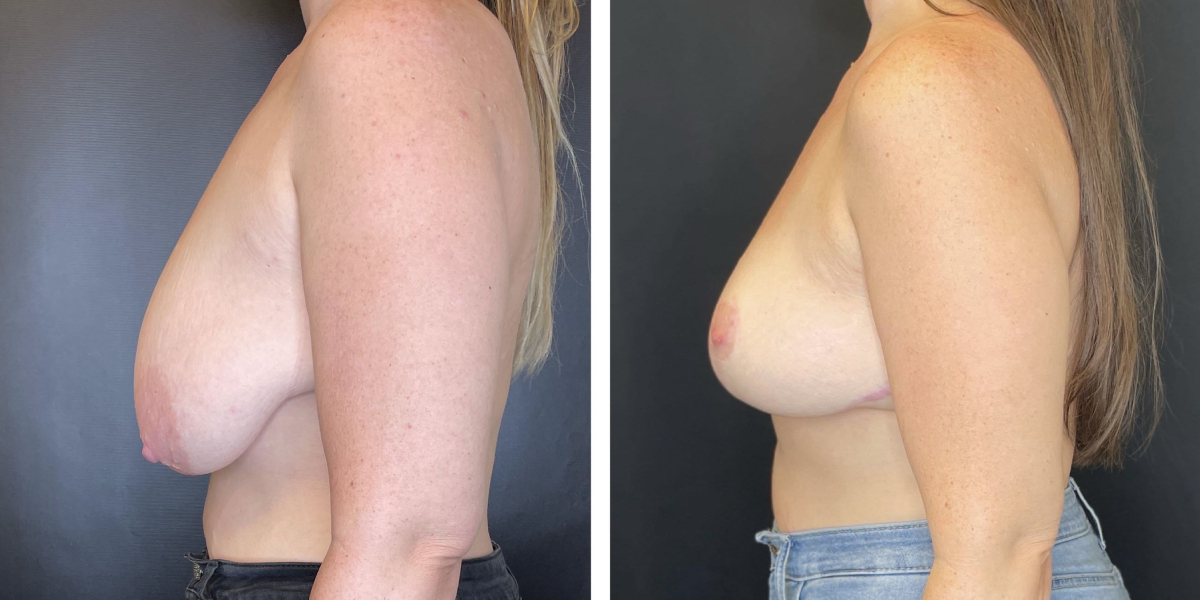 before and after breast lift left side view female patient case 1317