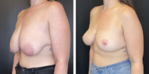 before and after breast lift left angled view case 1317