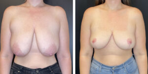 before and after breast lift front view female patient case 1317