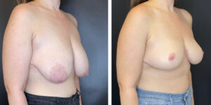 before and after breast lift right angled view case 1317