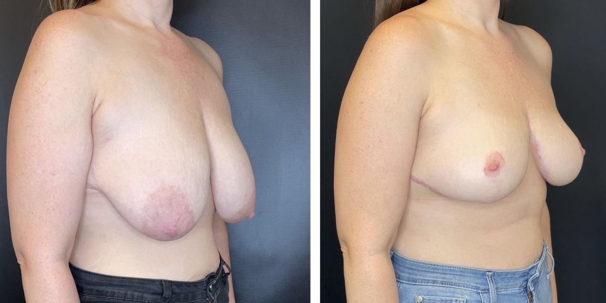 before and after breast lift right angled view case 1317