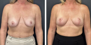 before and after breast lift front view female patient case 1323