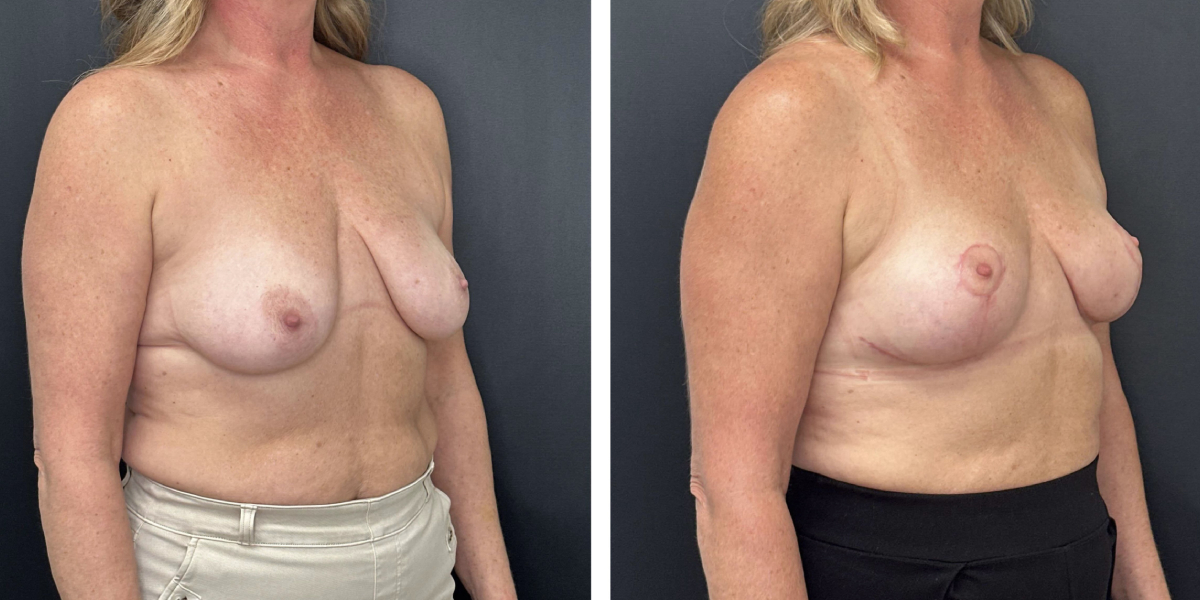 before and after breast lift right angled view female patient case 1323