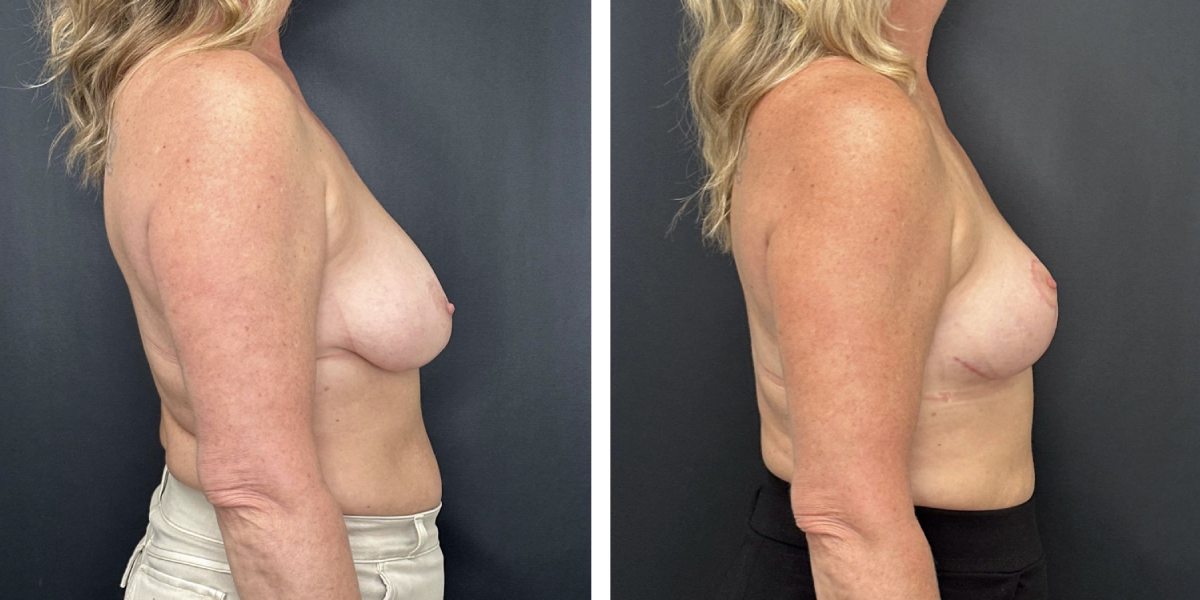 before and after breast lift right side view female patient case 1323