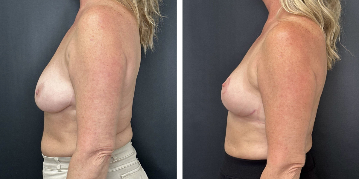 before and after breast lift left side view female patient case 1323