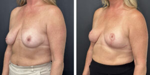 before and after breast lift left angled view female patient case 1323