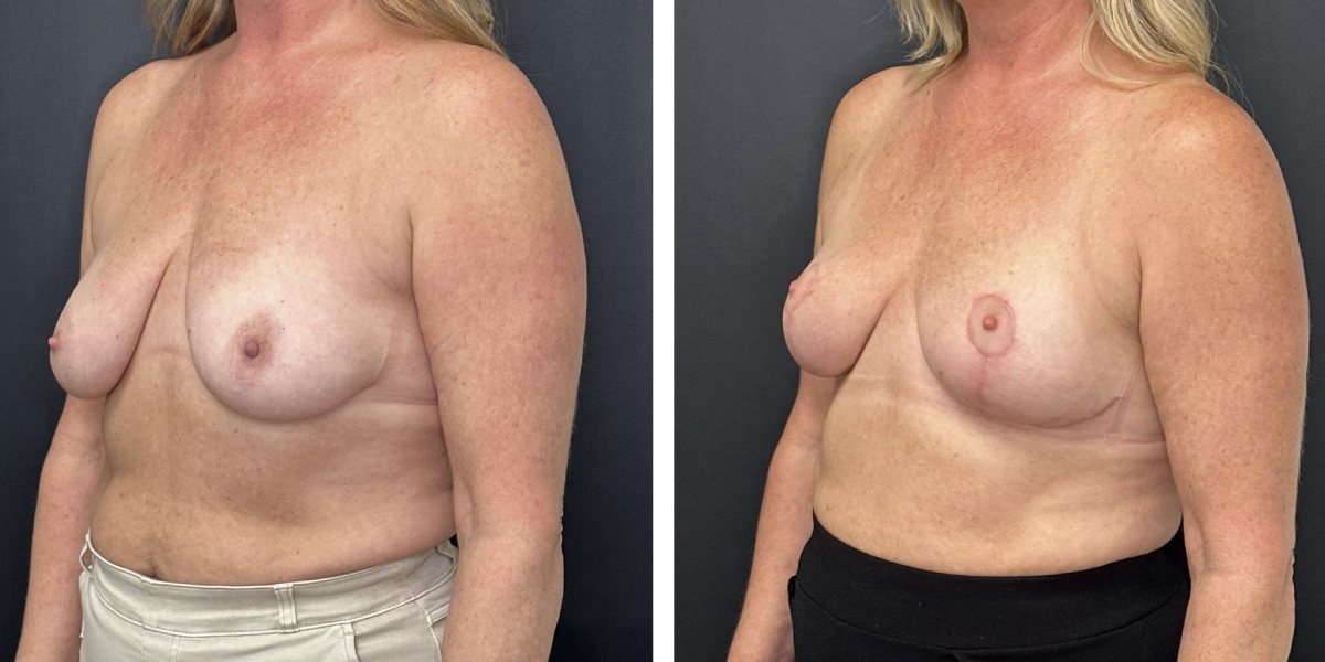 before and after breast lift left angled view female patient case 1323