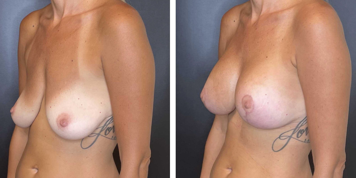 before and after breast lift with augmentation left angled view case 1430