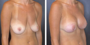before and after breast lift with augmentation right angled view case 1430