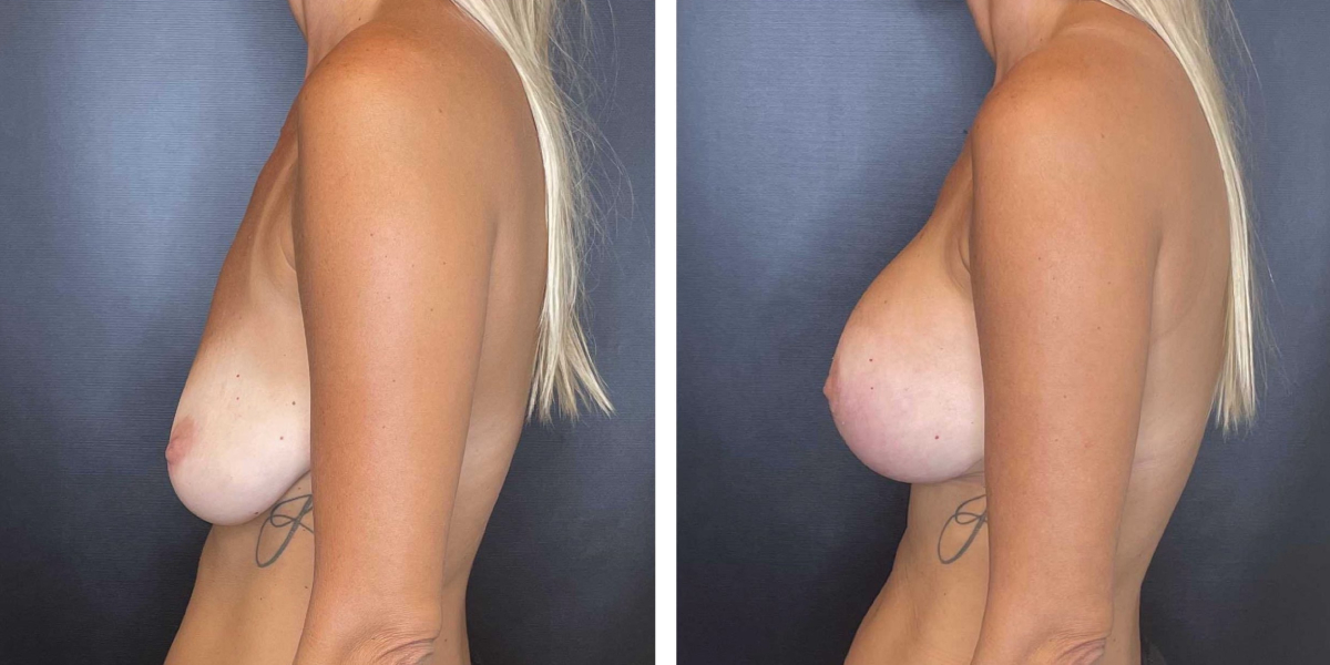 before and after breast lift with augmentation left side view case 1430