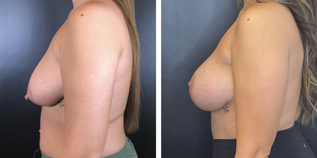 before and after breast lift with augmentation left side view case 1436