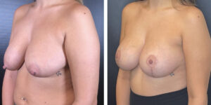 before and after breast lift with augmentation left angled view case 1436