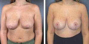 before and after breast lift with augmentation front view case 1436