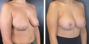 before and after breast lift with augmentation right angled view case 1436