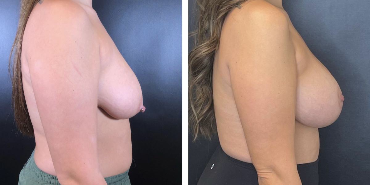 before and after breast lift with augmentation right side view case 1436