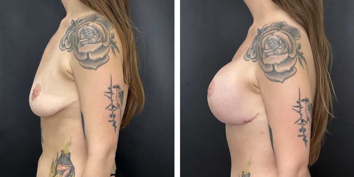 before and after breast lift with augmentation left side view case 1601