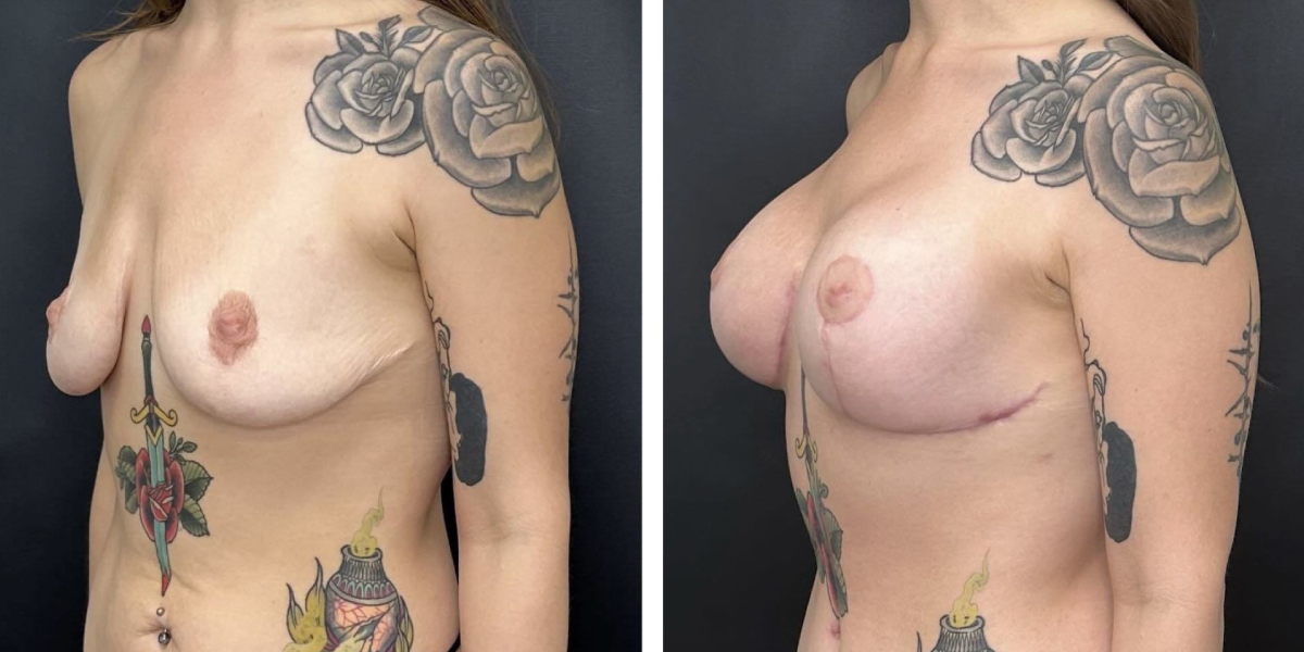 before and after breast lift with augmentation left angled view case 1601