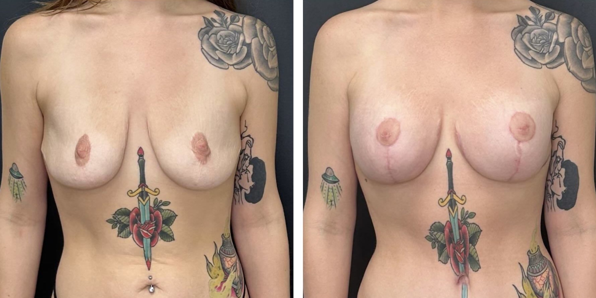 before and after breast lift with augmentation front view case 1601