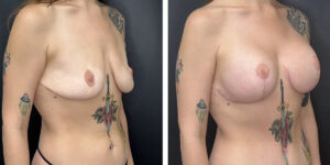 before and after breast lift with augmentation right angled view case 1601