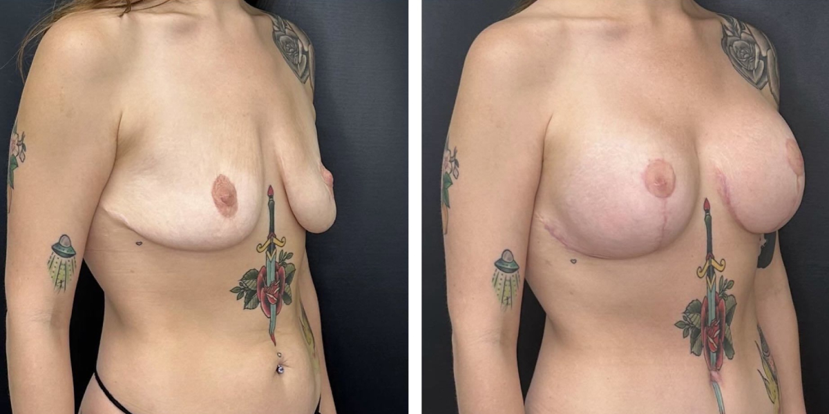 before and after breast lift with augmentation right angled view case 1601