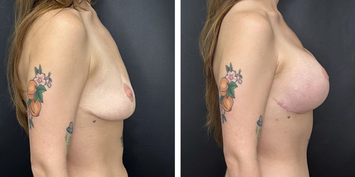before and after breast lift with augmentation right side view case 1601
