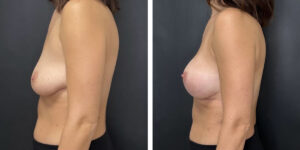 before and after breast lift with augmentation left side view case 1607