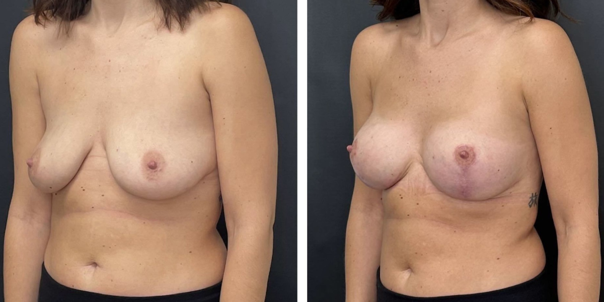 before and after breast lift with augmentation left angled view case 1607