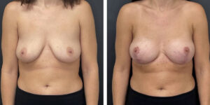 before and after breast lift with augmentation front view case 1607