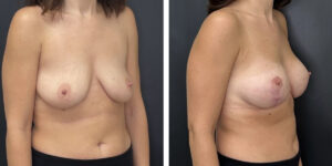 before and after breast lift with augmentation right angled view case 1607