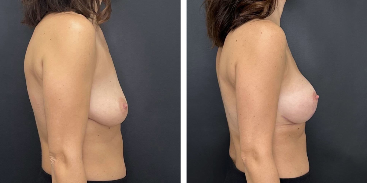 before and after breast lift with augmentation right side view case 1607