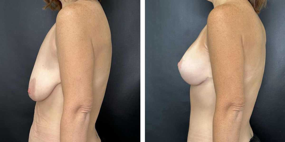 before and after breast lift with augmentation left side view case 1613