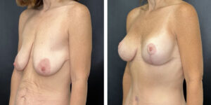 before and after breast lift with augmentation left angled view case 1613
