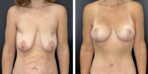 before and after breast lift with augmentation front view case 1613