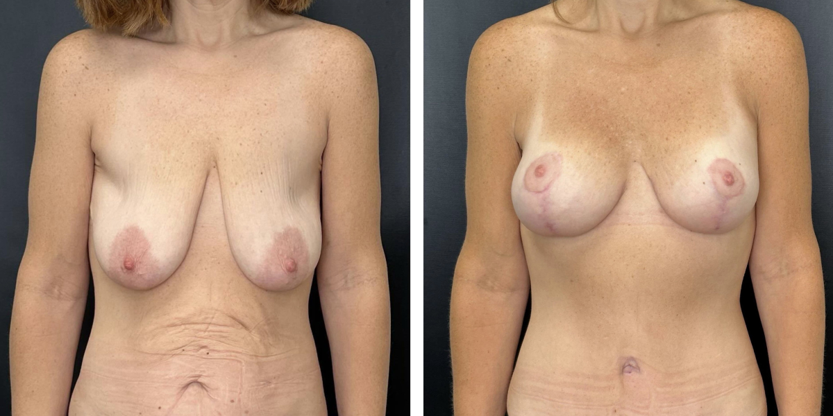 before and after breast lift with augmentation front view case 1613
