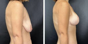 before and after breast lift with augmentation right side view case 1613