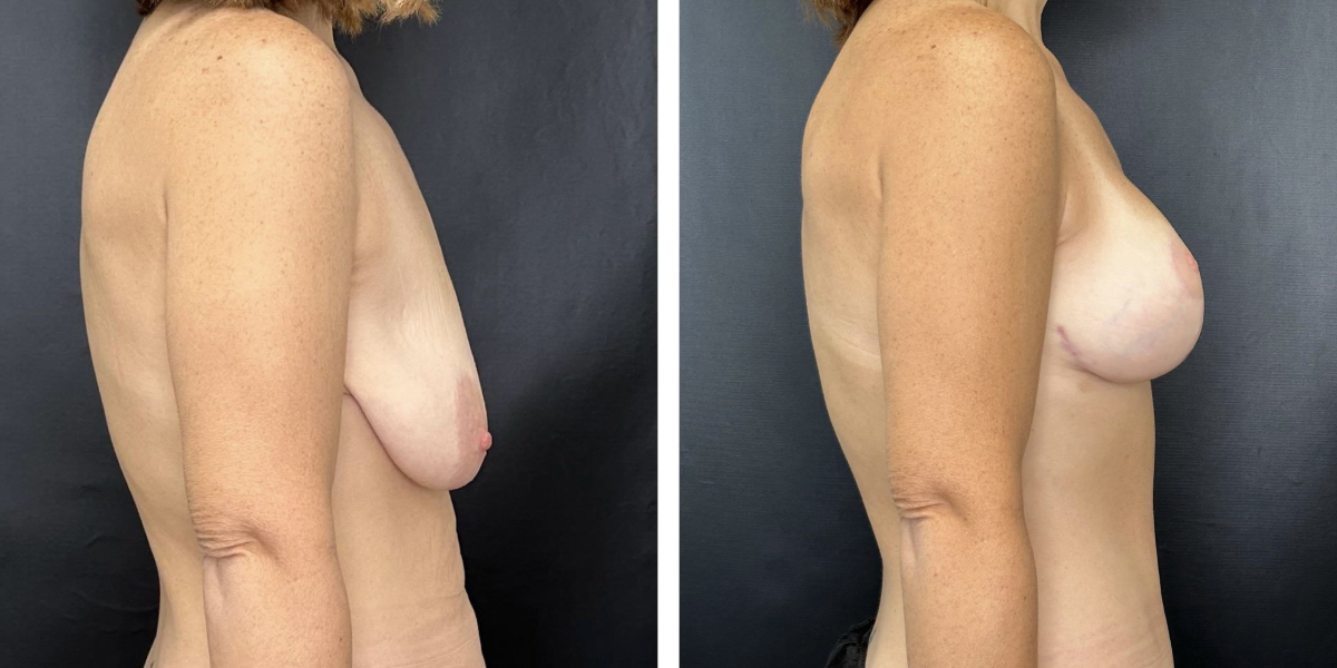 before and after breast lift with augmentation right side view case 1613