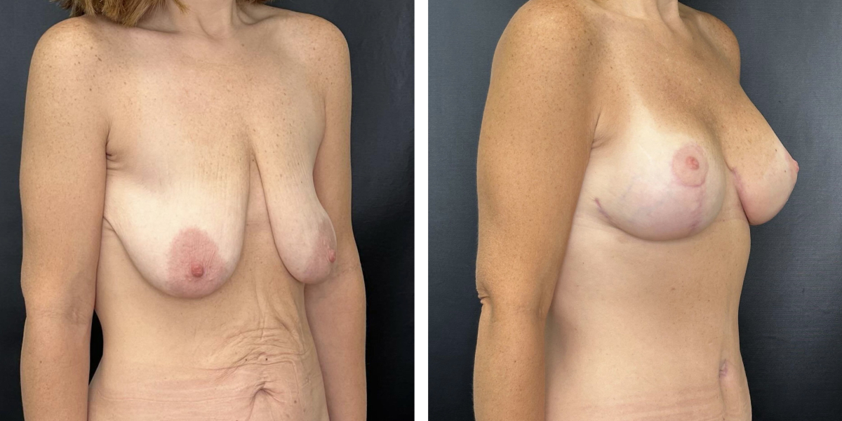 before and after breast lift with augmentation right angled view case 1613