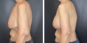 before and after breast lift with augmentation left side view case 1619