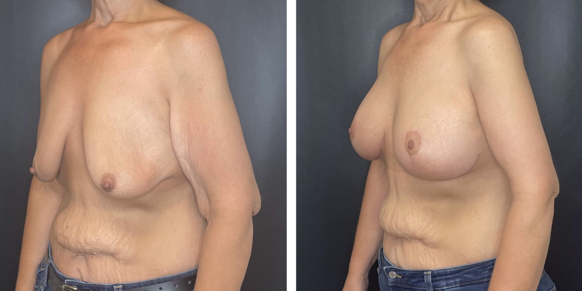 before and after breast lift with augmentation left angled view case 1619