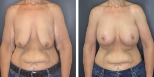 before and after breast lift with augmentation front view case 1619