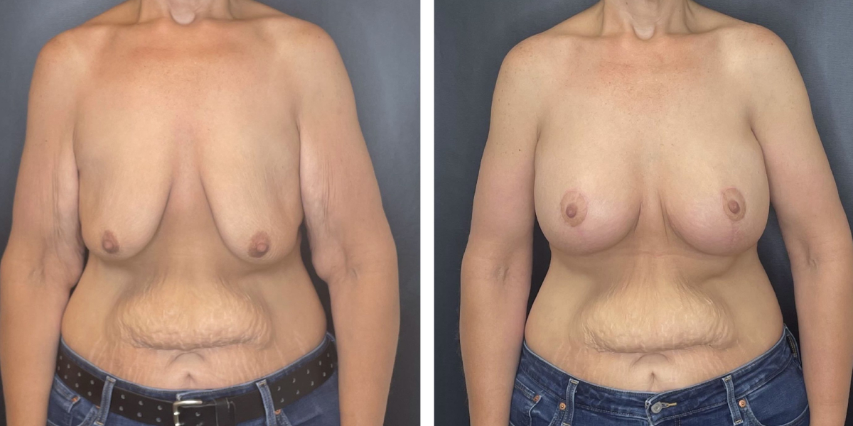 before and after breast lift with augmentation front view case 1619