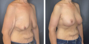before and after breast lift with augmentation right angled view case 1619