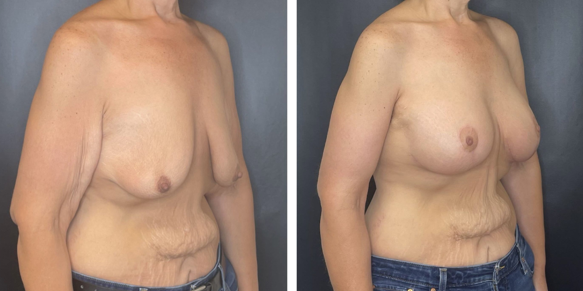 before and after breast lift with augmentation right angled view case 1619