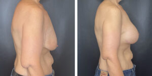 before and after breast lift with augmentation right side view case 1619