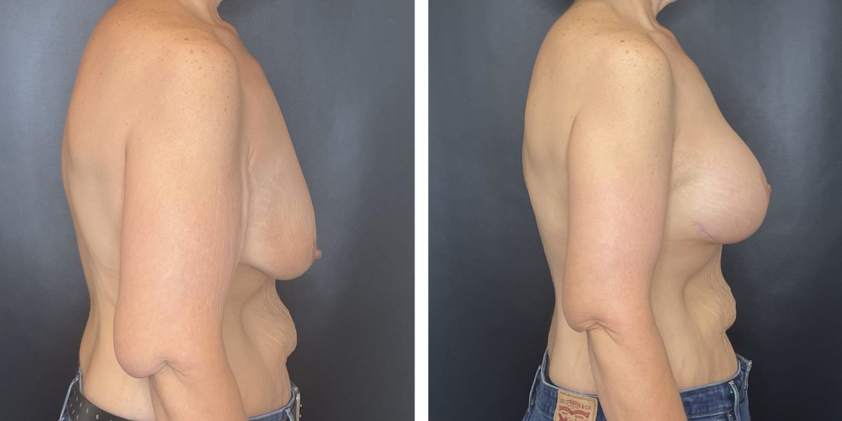 before and after breast lift with augmentation right side view case 1619