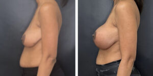before and after breast lift with augmentation left side view case 1625