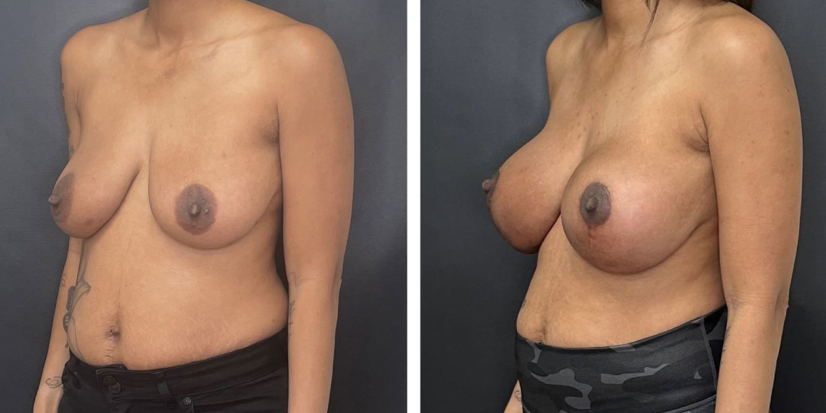before and after breast lift with augmentation left angled view case 1625