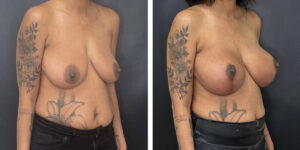 before and after breast lift with augmentation right angled view case 1625